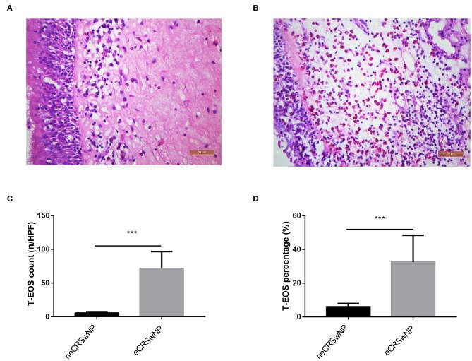 A szérum metabolizmusának szerepe a krónikus rhinosinusitis és az orrpolip fenotípusok megkülönböztetésében